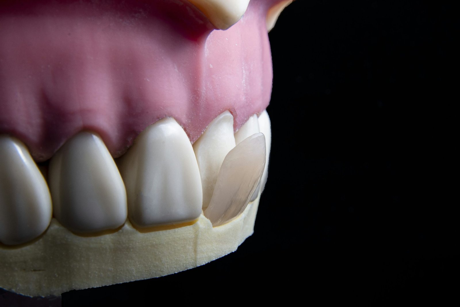Managing Tooth Sensitivity After a Zirconia Bridge