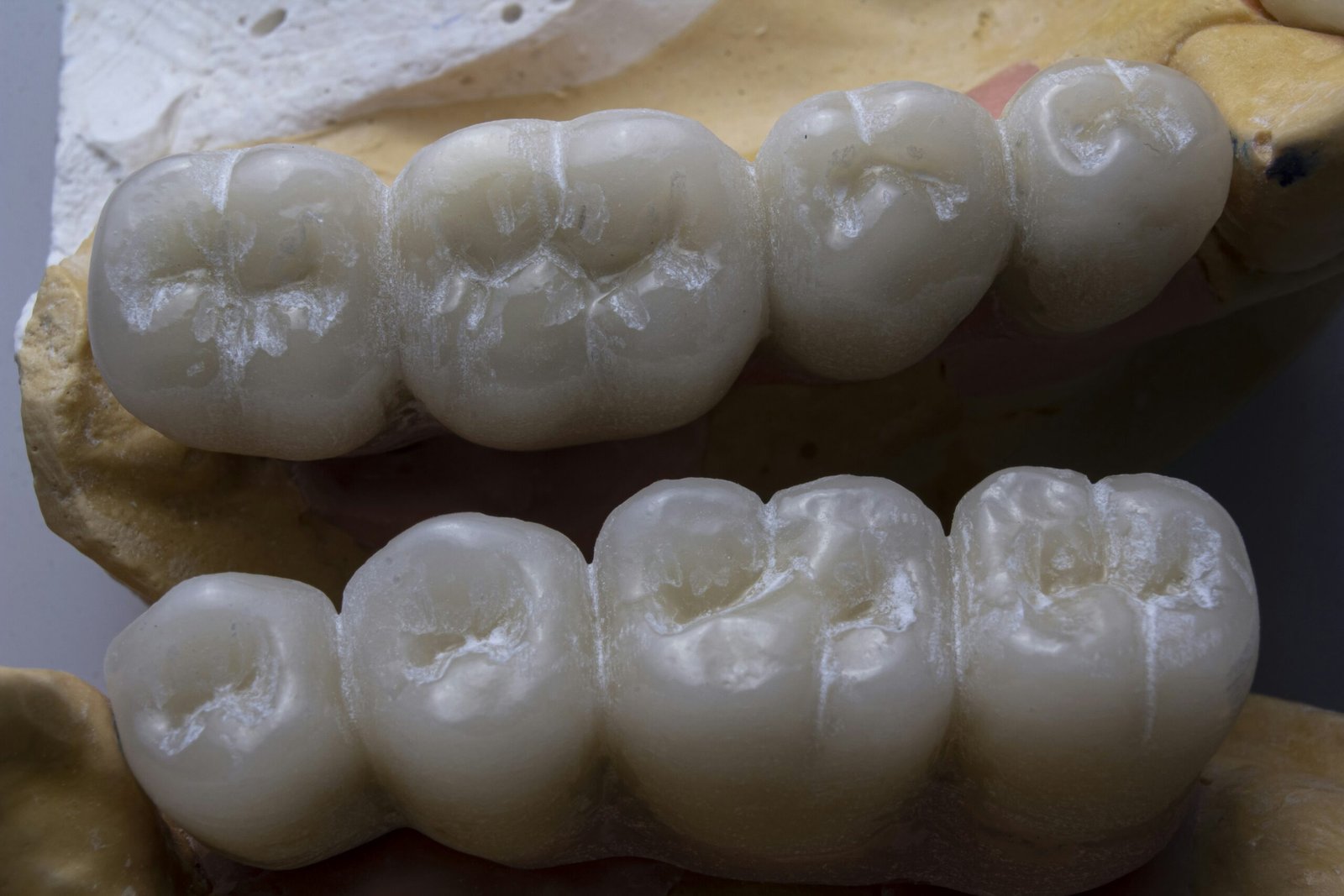 Are Zirconia Bridges Stain-Proof? Coffee