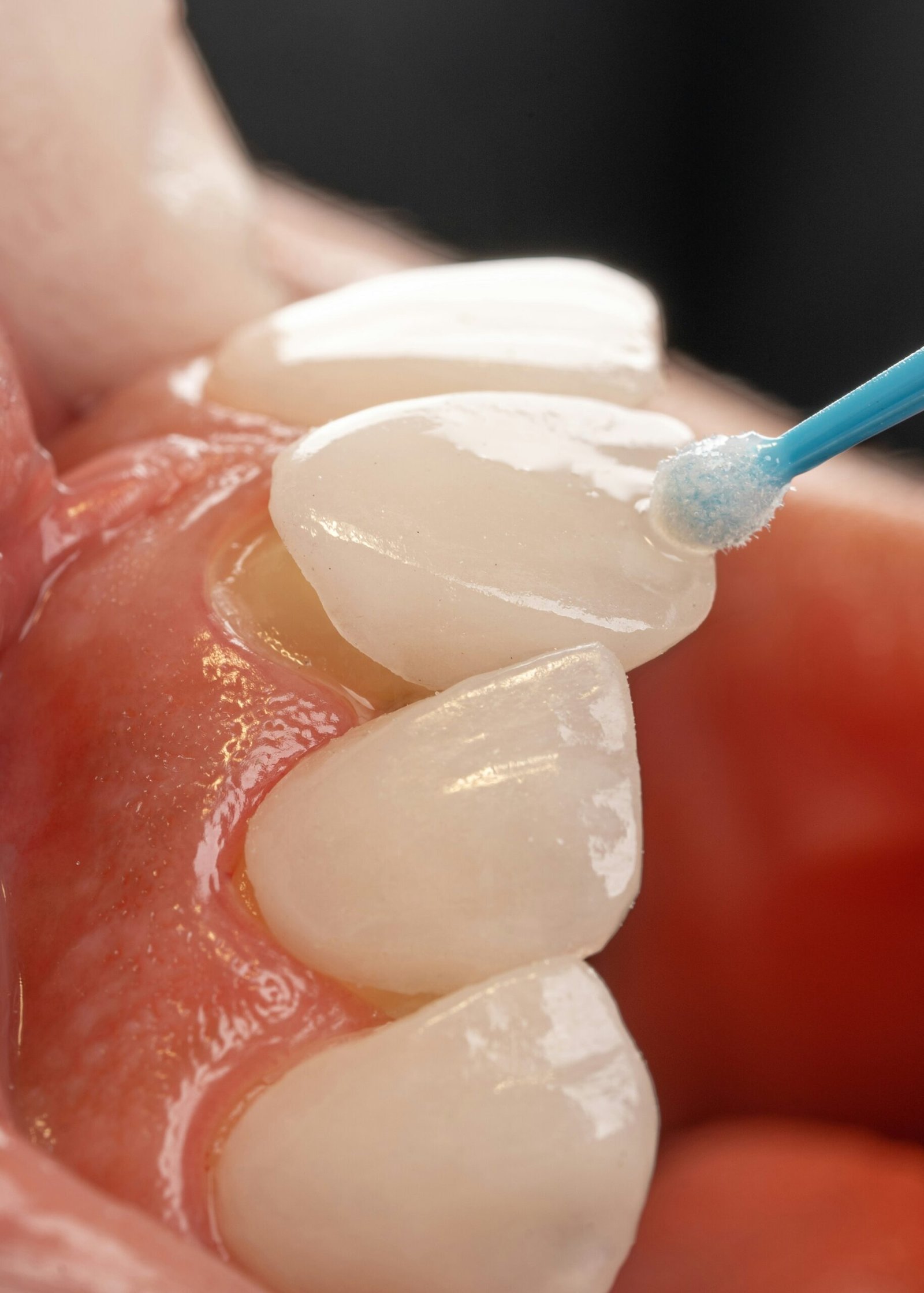 Zirconia Bridge Aftercare: How to Clean Your Bridge