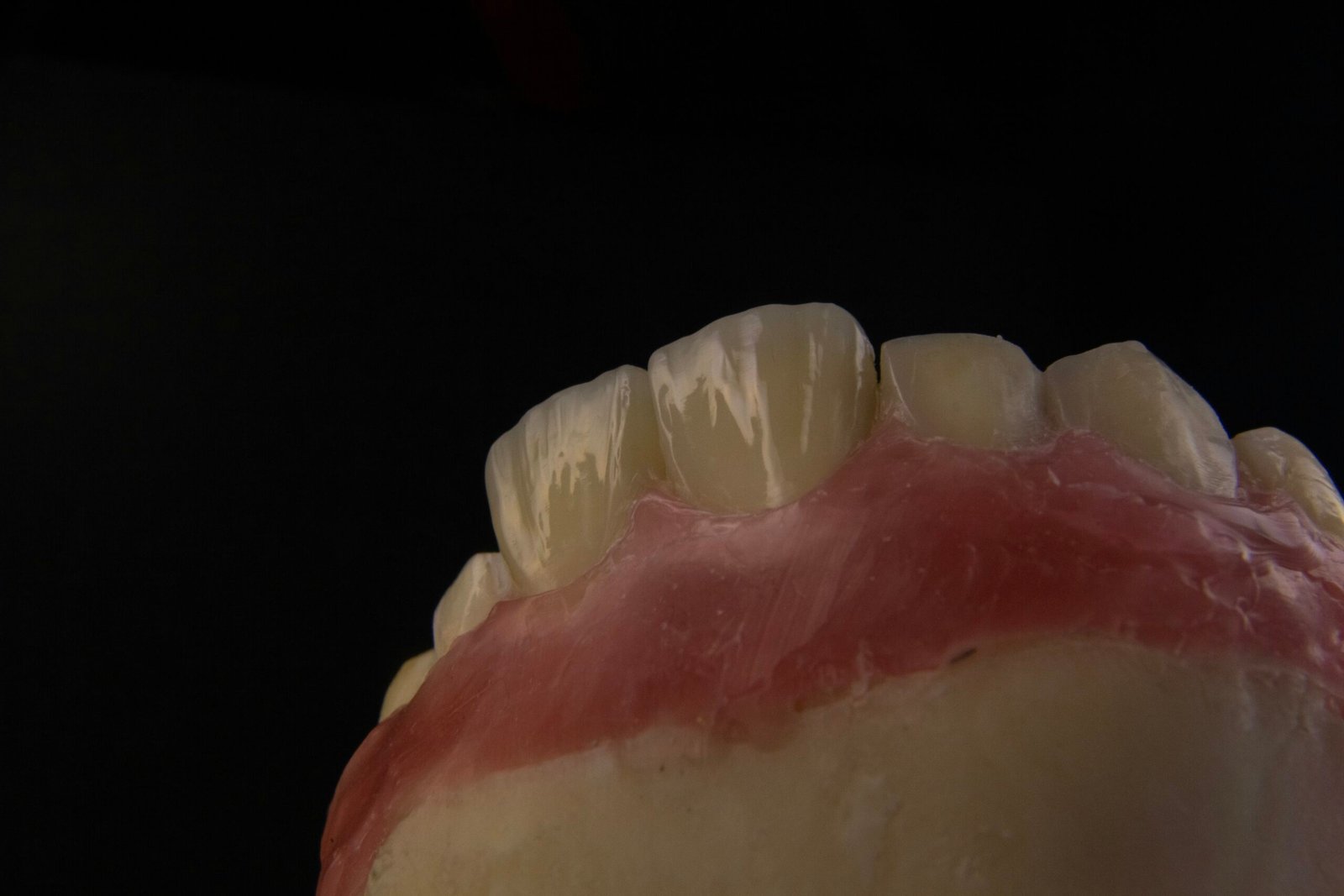 Managing Gum Recession Around a Zirconia Bridge