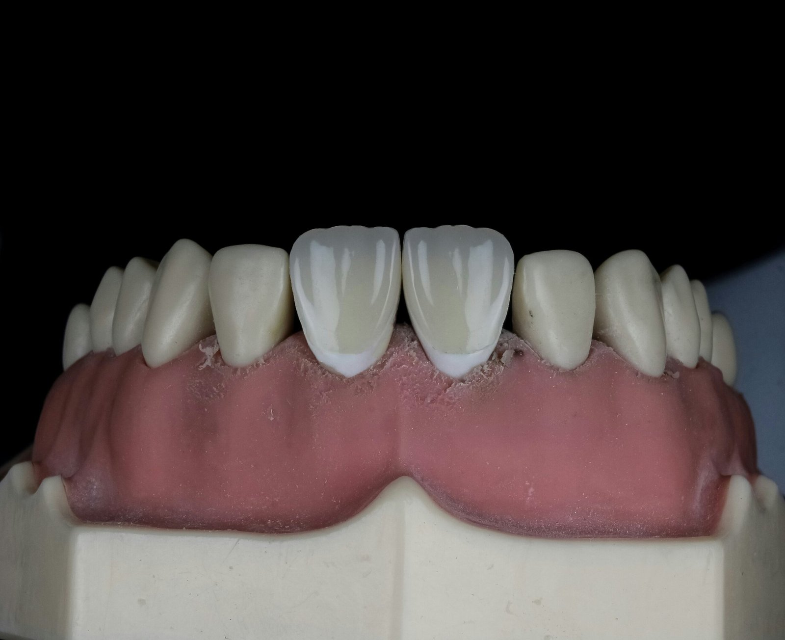 Managing Hot and Cold Sensitivity with Zirconia Bridges